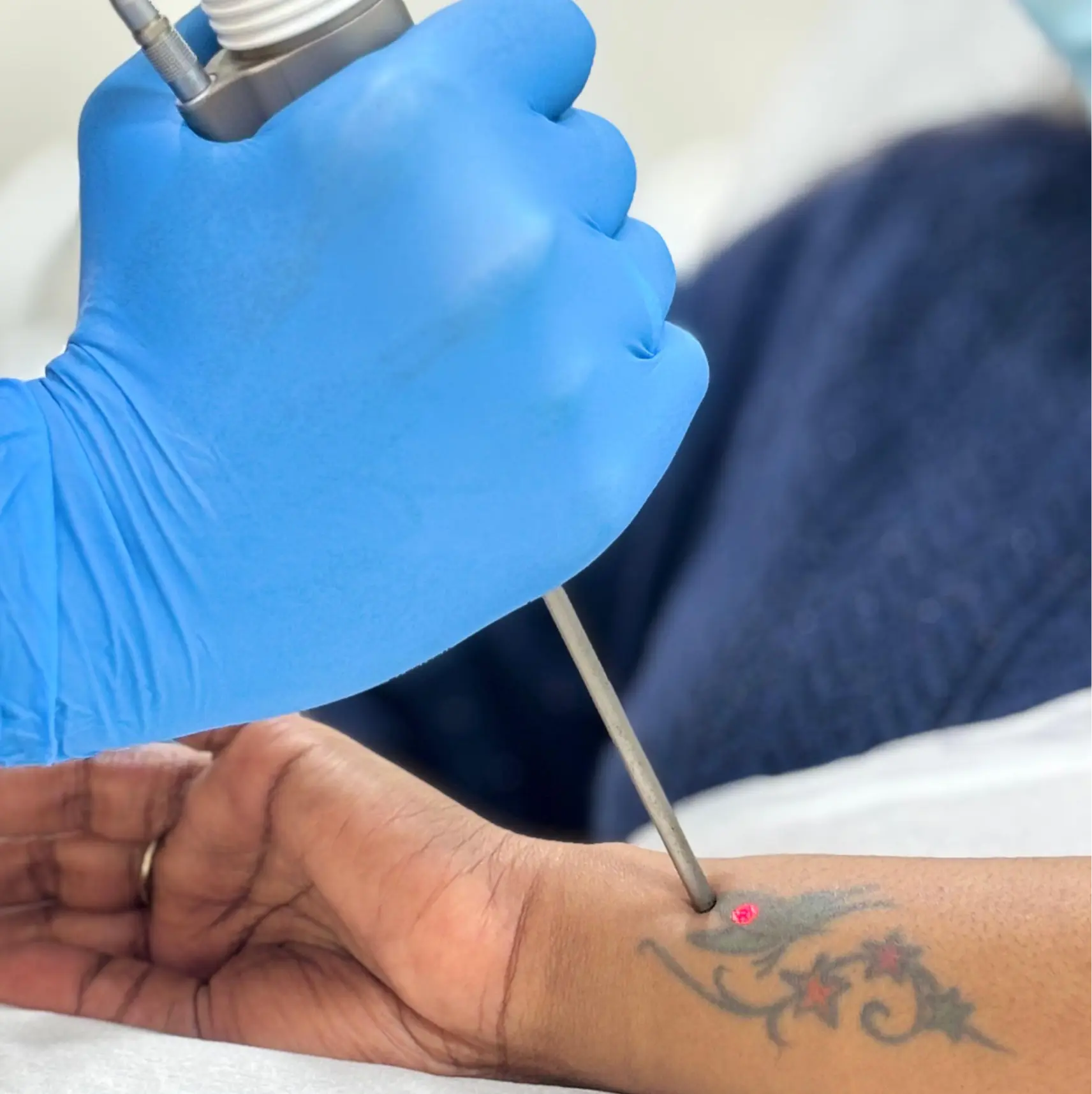 fotona laser tattoo removal